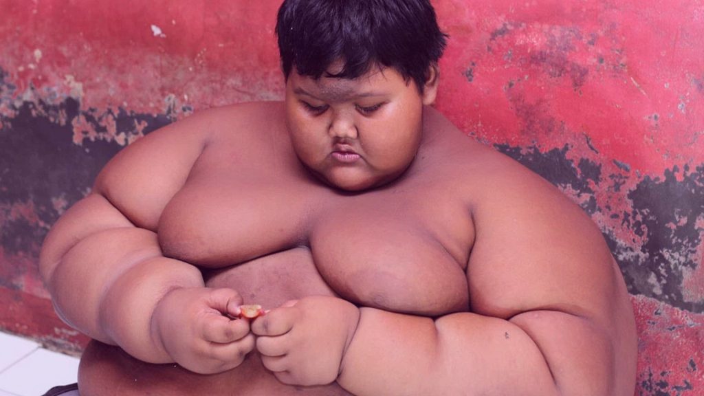 Obesitas Pada Anak (Arya)